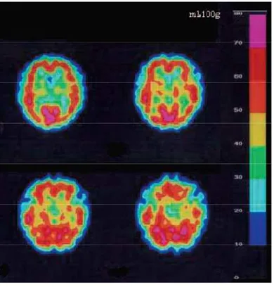 Figure  14 :  brain  SPECT  en  utilisant  le  Tc99m-ECD ;  montre  une  augmentation  de  l’absorption  du  radio  traceur  (augmentation  du  débit  sanguin)  dans  les  lobes  temporaux  latéraux, en particulier dans le côté droit, et une diminution de 