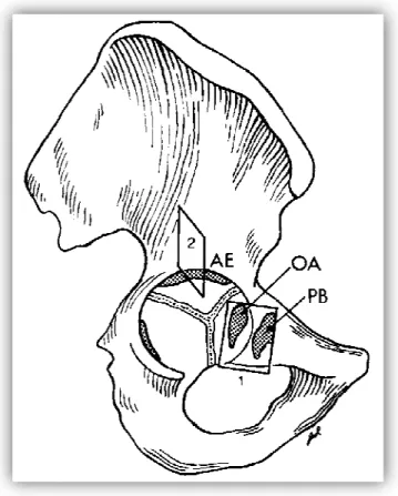 Figure 10 : Schéma de l'os coxal droit d'un adolescent représentant les différents noyaux  d’ossification