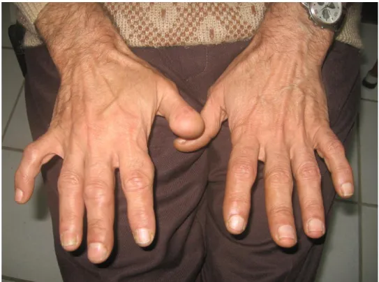Figure 1. Mains typiques d’un acromégale 