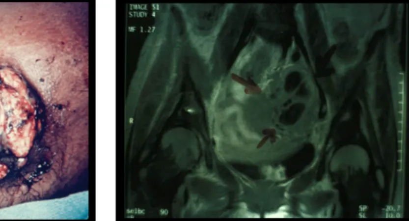 Figure 13 : IRM : masse abdominale     actinomycosique [76]. 