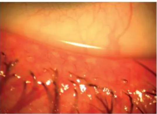 Figure 5 : Inflammation du bord libre avec télangiectasies [62]. 