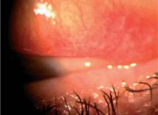 Figure 9 : Fibrose conjonctivale dans une rosacée oculaire [62]. 