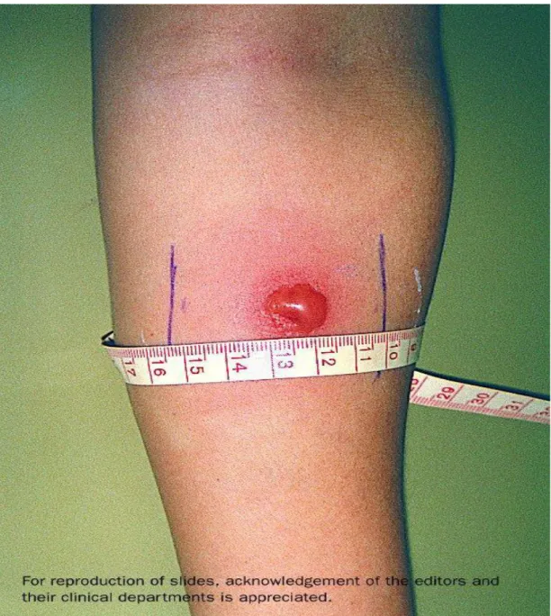 Figure 23 : Intradermoréaction à la tuberculine lue entre la 48e et la 72e heure  [50]