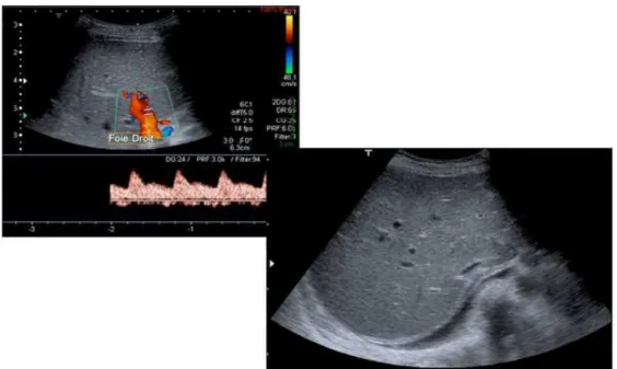 Figure n°9 : Echographie-doppler hépatique   L'échographie-doppler:  