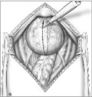 Figure  17 :  cystoplastie  bivalve :  les  berges  vésicales  sont  marquées  par  des  fils  repères  permettant  une  exposition  du  trigone  vésical  afin  d‟intuber les uretères par des sondes
