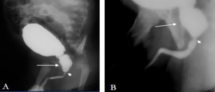 Figure n°9 : A et B, UCG en temps mictionnel. 2 cas de valves de l‟urètre postérieur :   Dilatation de l‟urètre postérieur (flèche), en amant de la valve (tète de la flèche) (40) 