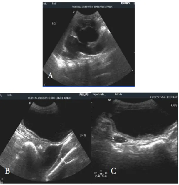 Figure n° 10: échographie de l‟arbre urinaire chez un nouveau né (J2) porteur d‟une valve de l‟urètre