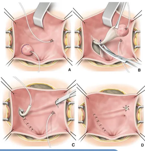 Figure n°10. Exérèse d’une urétérocèle sur uretère simple. 