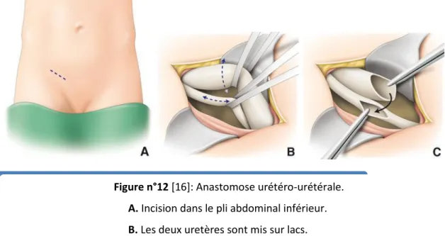 Figure n°12 [16]: Anastomose urétéro-urétérale. 