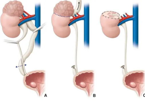 Figure n°13.[16] Néphro-urétérectomie polaire supérieure. 