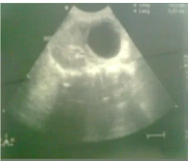 Figure 13 : Echographie abdominale montrant un KHR type I 