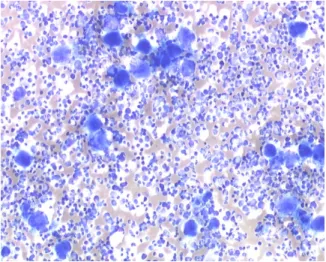 Figure 11 : Etalement médullaire richement cellulaire,   avec nombreux mégacaryocytes (de taille normale ou réduite) [15] 