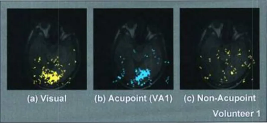 Figure 6 : Correspondance entre l’activation des lobes occipitaux et la stimulation  des points d’acupuncture, spécifiques de la vision 