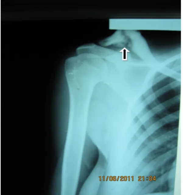Figure 6 : radiographie standard de l’épaule droite. 