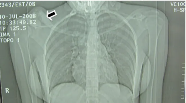 Figure 9 : topogramme thoracique montrant les images lytiques   de l’extrémité distale de la clavicule  