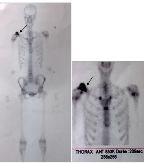 Figure 10 et 11: scintigraphie osseuse montrant l’hyperfixation précoce du produit  radio-isotope 