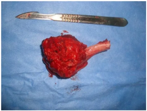 Figure 16 : Pièce opératoire montrant le tiers distal de la clavicule   (5cm) contenant la tumeur mesurant 3cm
