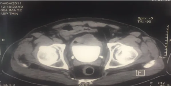 Figure 9 : Cliché de TDM montrant une tumeur de la face antérieur de la vessie   (Service d'urologie A CHU RABAT) 
