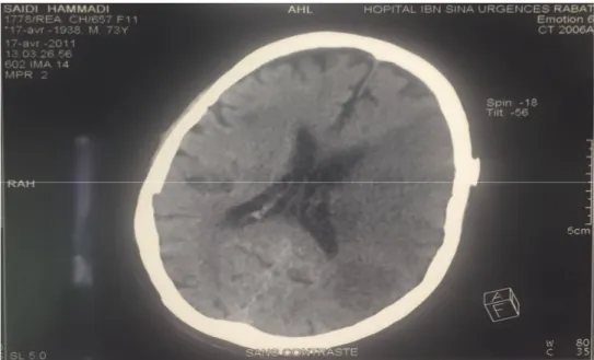 Figure 10 : TDM cérébral montrant un AVC ischémique étendu dans le territoire de  l'artère sylvienne gauche (service d'Urologie A CHU RABAT)