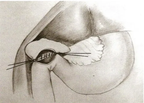 Figure  6:  Anastomose  cholécysto-dudénale  entre  la  face  antérieure  de  la  vésicule  biliaire  et  la  face  interne  du  premier  duodénum  (Reproduit  d’après  GAY V