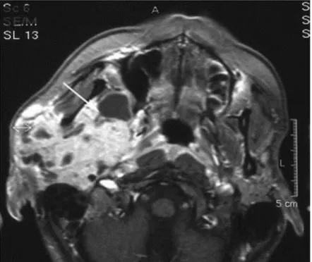 Figure 21 : Carcinome adénoïde kystique de la glande parotide droite  s'étendant jusqu'à l'espace parapharyngé et à la FIT (flèche) [60]