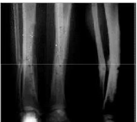 Fig. 1 – Plaque condylienne de soutien AO 