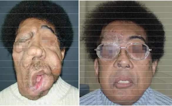 Figure 4:  Pascal avant et après greffe de visage (équipe du Pr Lantieri)   