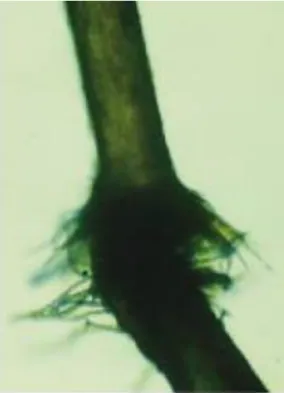 Figure 9: Trichorrhexie noueuse : aspect microscopique d’une tige pilaire (51). 