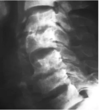 Figure 22 : Radiographie de profil du rachis cervical amylose bêta2-microglobulinique