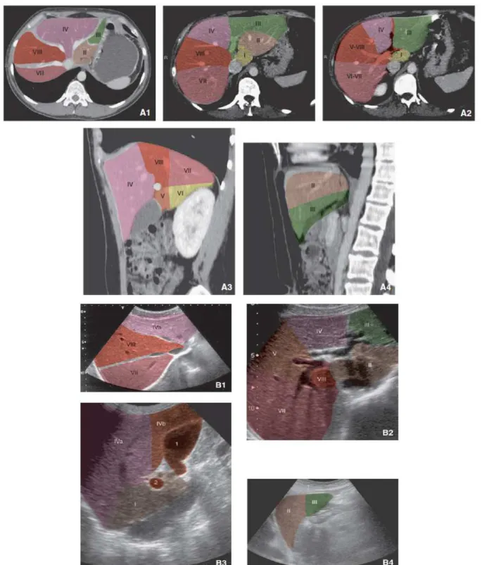 Figure 10 : Segmentation hépatique en scanner (A), en échographie (B). Coupes axiales  passant par le plan des veines hépatiques (A1, B1) et de la bifurcation portale (A2,B2)