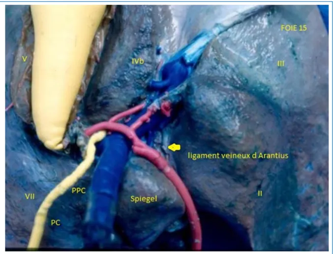 Figure 13:  Vue du lobe dorsal et ses rapports avec les éléments du pédicule  hépatique  et les autres segments du foie