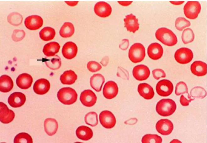 Figure 8: Sidérocytes contenant les corps de Pappenheimer dans l'anémie  sidéroblastique 