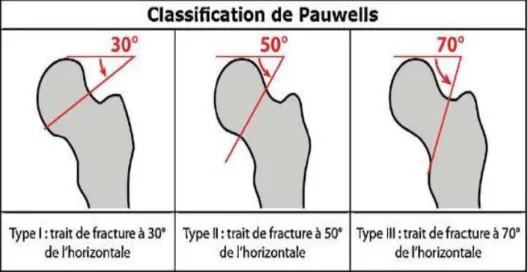 Figure 2 : Classification de Pauwels des fractures du col fémoral (12) 