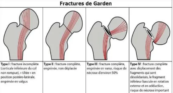 Figure 3 : Classification de Garden de la fracture du col fémoral (12) 