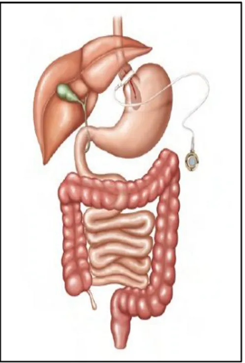 Figure 3 : Anneau gastrique ajustable [58] 