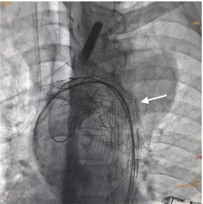 Figure 8: Une angiographie dirigée par cathéter après débranchement  démontrant un contrôle angiographique final après réparation d’un  anévrysme endovasculaire thoracique révélant une exclusion de 
