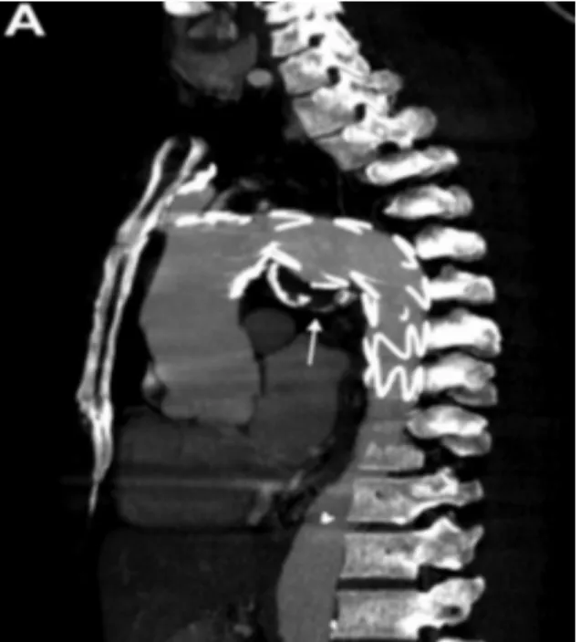 Figure 9A : Une image d’une coupe sagittale d’une angiographie par  tomodensitométrie de contrôle post opératoire de 3 mois révélant une 