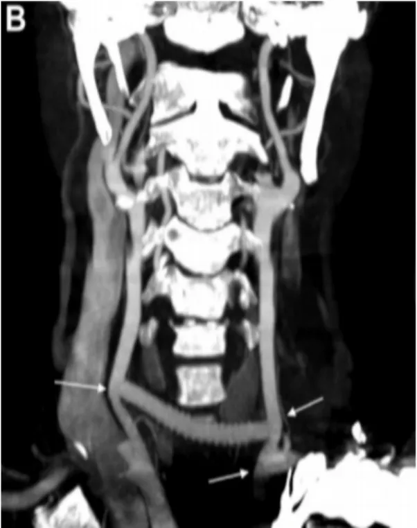 Figure 9 B: une image d’une coupe frontale du CTA montrant une bonne  perméabilité du pontage carotidien (flèche) et de la transposition de l’artère 