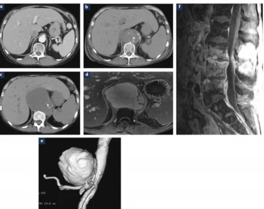 Figure 12 : Un anévrisme fongique au niveau de l’aorte abdominale sus  rénale d’une femme âgée de 53 ans, hémodialysée chronique et ayant une 