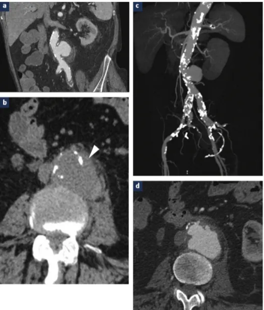 Figure 13. Tomodensitométrie abdominale sans (b) et avec injection de  produit de contraste (a, d), reformations 3D MIP (c) d’un homme âgé de 78  ans présentant un anévrisme mycotique au niveau de l’aorte abdominale 