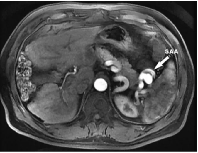 Figure 9 : Une IRM abdominale montrant un anévrisme de l'artère splénique (SAA=splenic  artery aneurism) [58] 