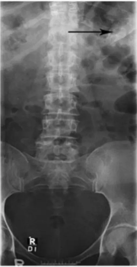 Figure 6  : Image radiographique montrant une lésion circulaire calcifiée se projetant dans  la partie supérieure gauche de l’abdomen en rapport avec un anévrisme de l'artère 