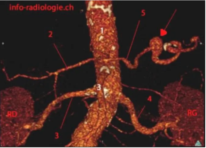 Figure 8 :  TDM abdominale (phase artérielle), Reconstruction3D : 1 : Aorte abdominale