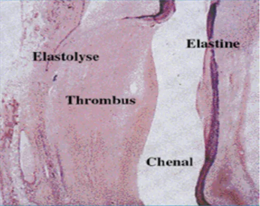 Figure 6: Image histologique modèle expérimental d’anévrisme aortique chez le rat,  provoqué par la perfusion localisée d’élastase réf [12]