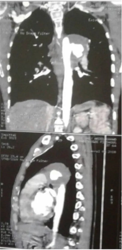 Figure 9: Reconstruction TDM du meme patient montrant l’anévrisme en regard de  l’isthme de l’aorte prenant naissance au pied de l‘artère sous Clavière gauche, 