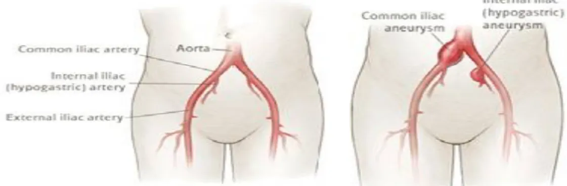 Figure 4: Anévrysme des artères iliaques[17] 