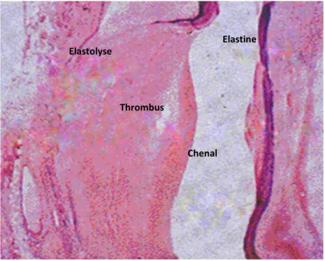 Figure 7: Image histologique d’un modèle expérimental d’anévrisme aortique chez  lerat,provoqué par la perfusion localisée d’élastase [24]