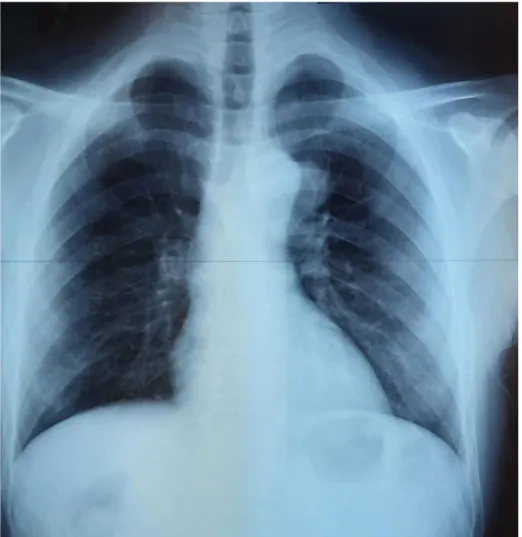 Figure 8: Radiographie de face montrant une image d’addition du bouton aortique.