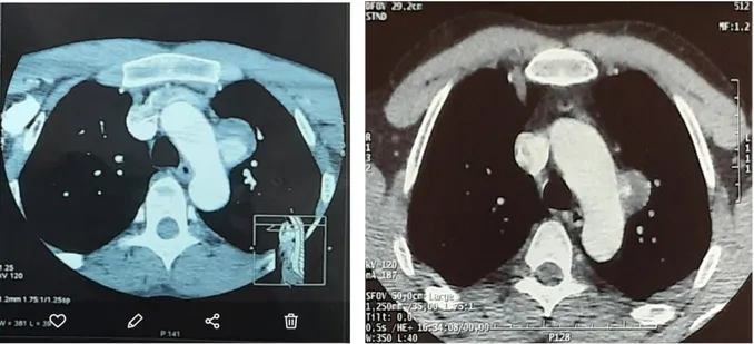 Figure 9: deux images d’angioscanner thoraciques faites à un ans d’intervalle. Le premier (à  gauche) montre un anévrisme de la crosse de l’aorte sans signe de rupture mesurant 22 mm x  25 mm avec collet mesurant 8 mm