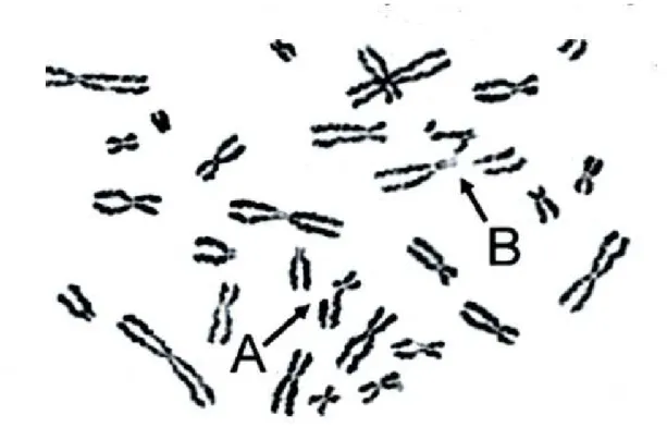 Figure 6: Résultat d'un test de cassure chromosomique  effectué sur une cellule  de patient FA(62)